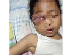 Menderita Tumor Mata, Asyifa Butuh Bantuan Pemerintah